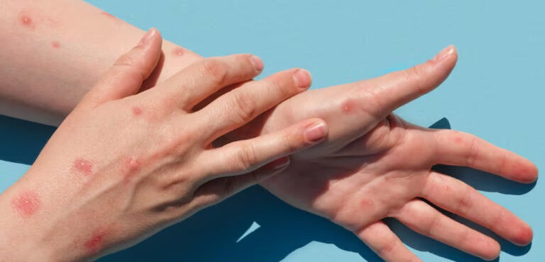 Primer caso de viruela símica en Escobar: un hombre de 38 años que evoluciona favorablemente en su domicilio